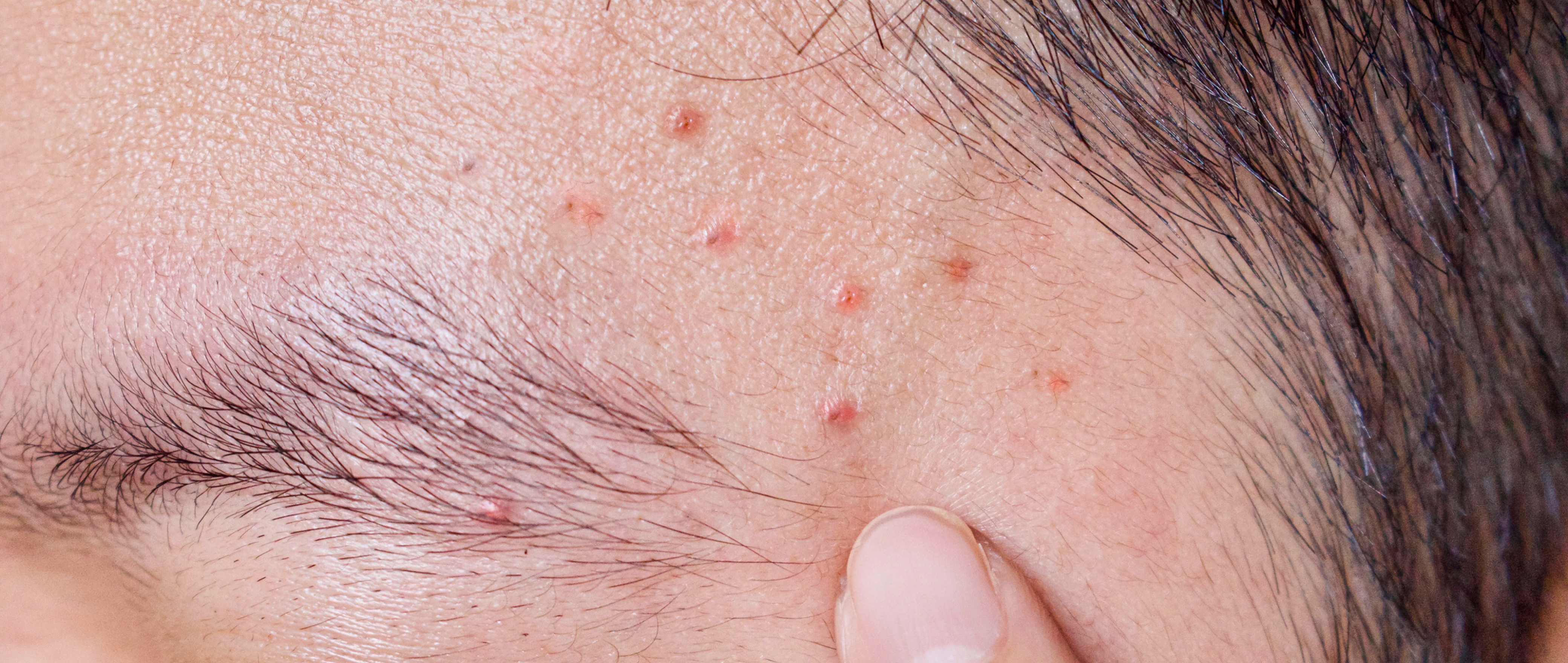 Hair Follicles Acting Up? Here’s All About Folliculitis