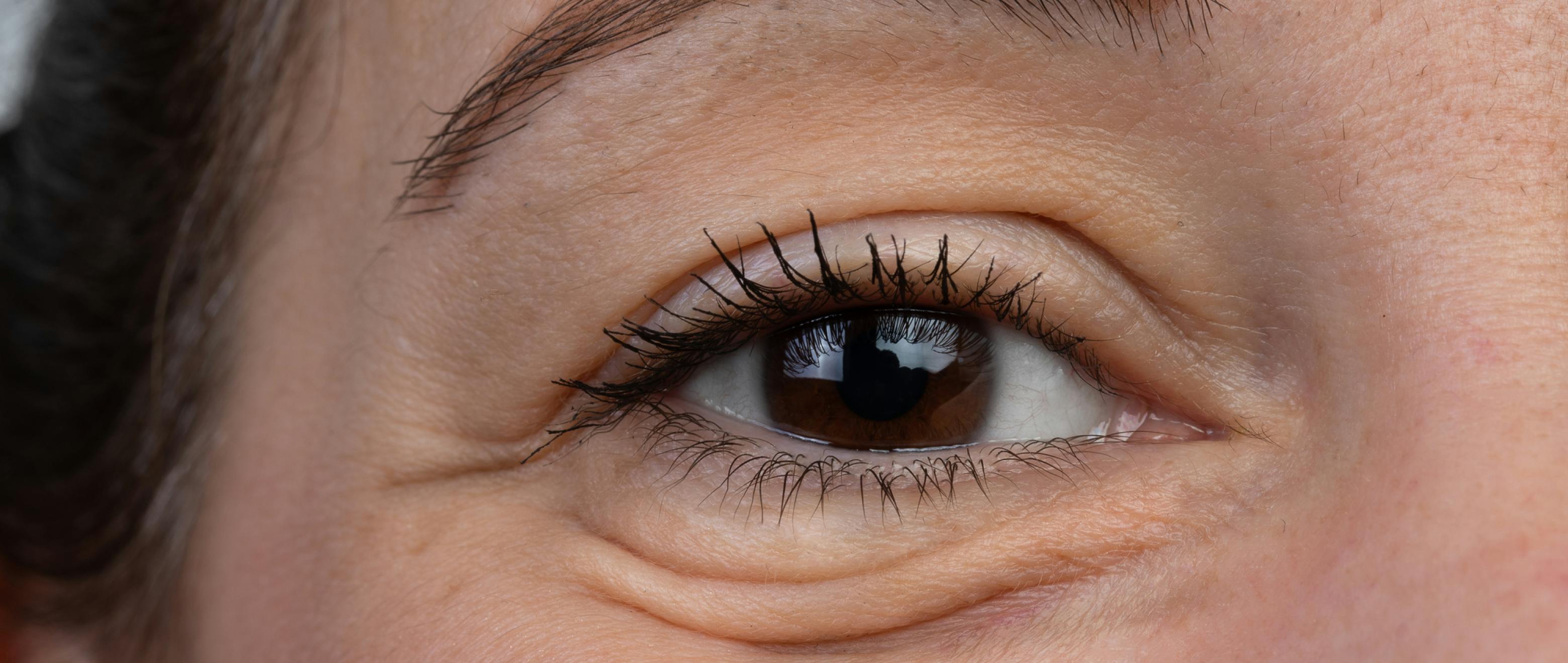 Bye-Bye Puffy Eyes: Here’s Our Complete Guide to Eye Puffiness