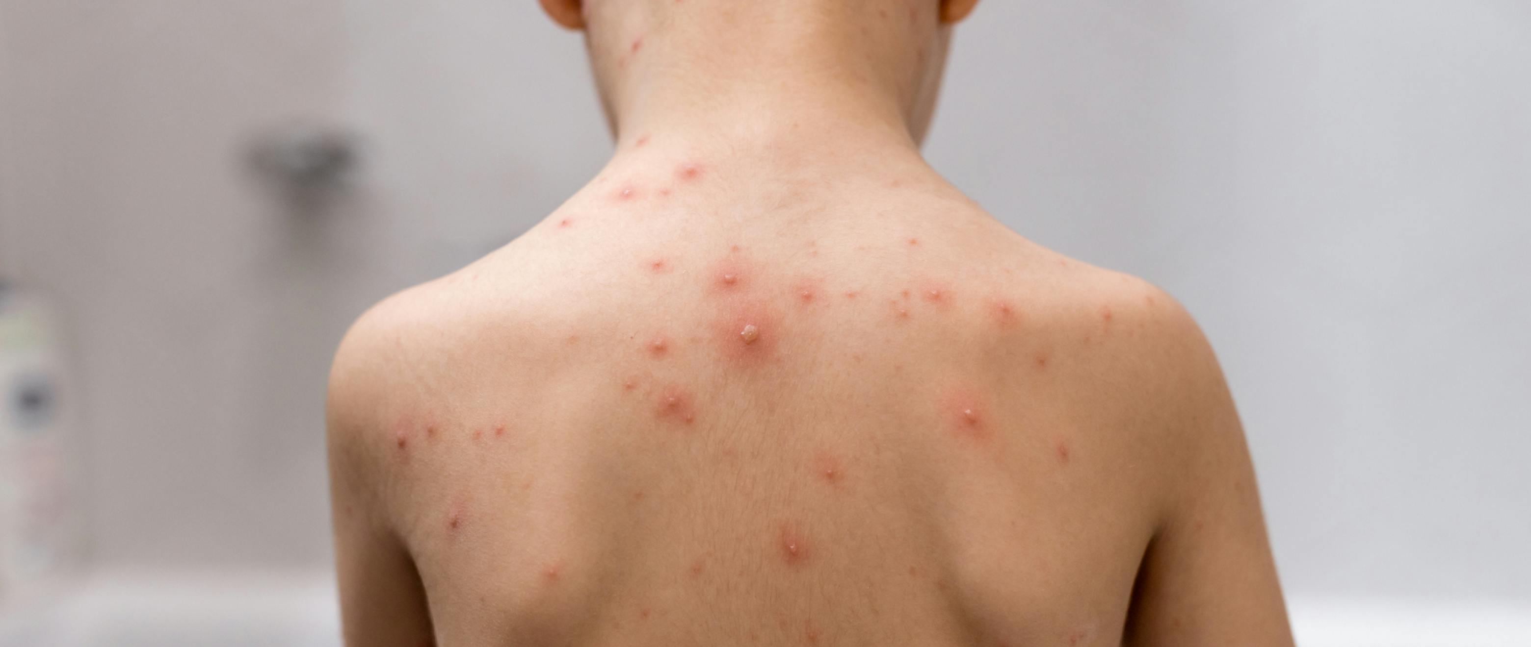 Don't Get Your Feathers Ruffled: Chickenpox Symptoms and Causes