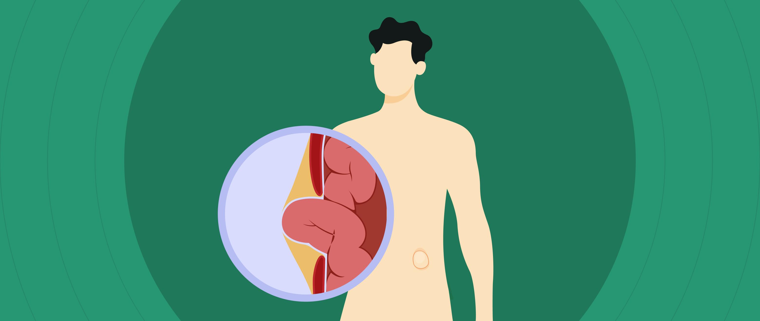 Hernia Alert: When Your Insides Decide to Make a Bold Exit