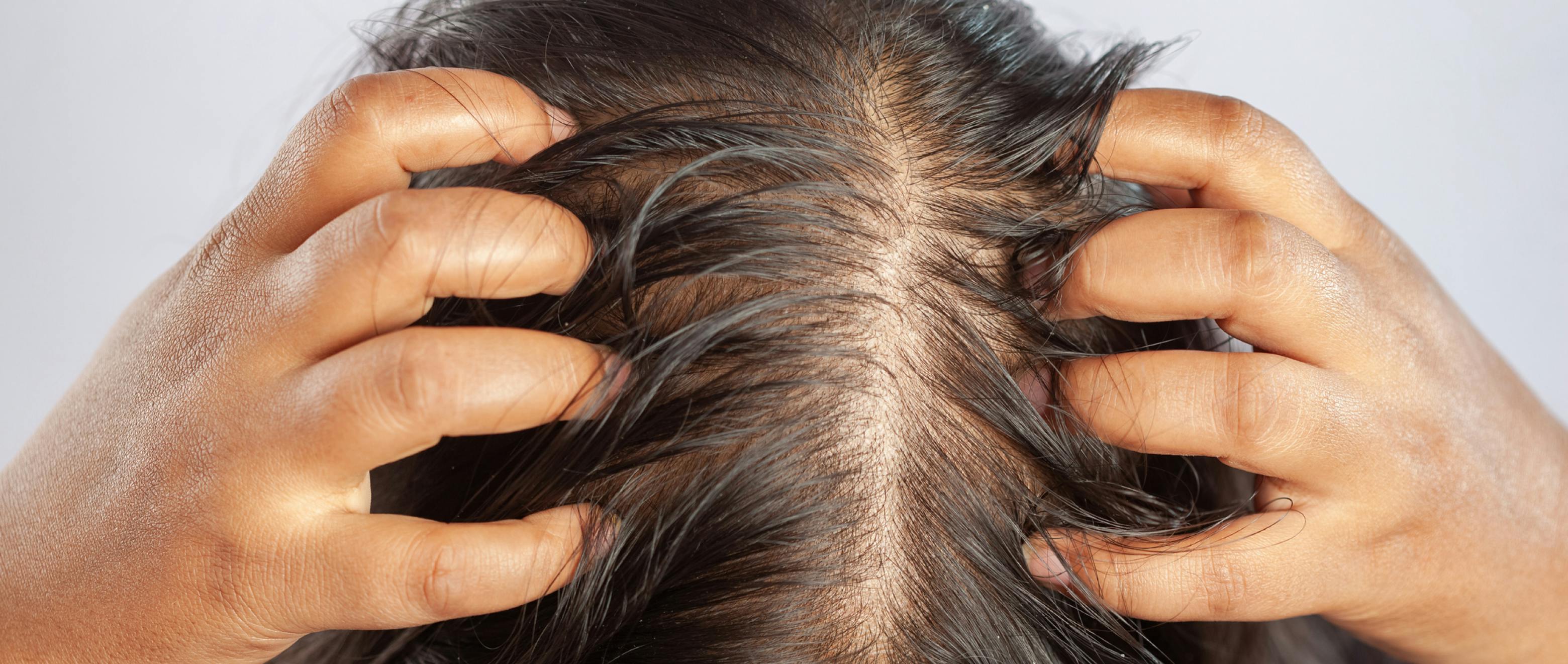 Hair Today, Gone Tomorrow? Here’s Your Guide to Female Pattern Baldness