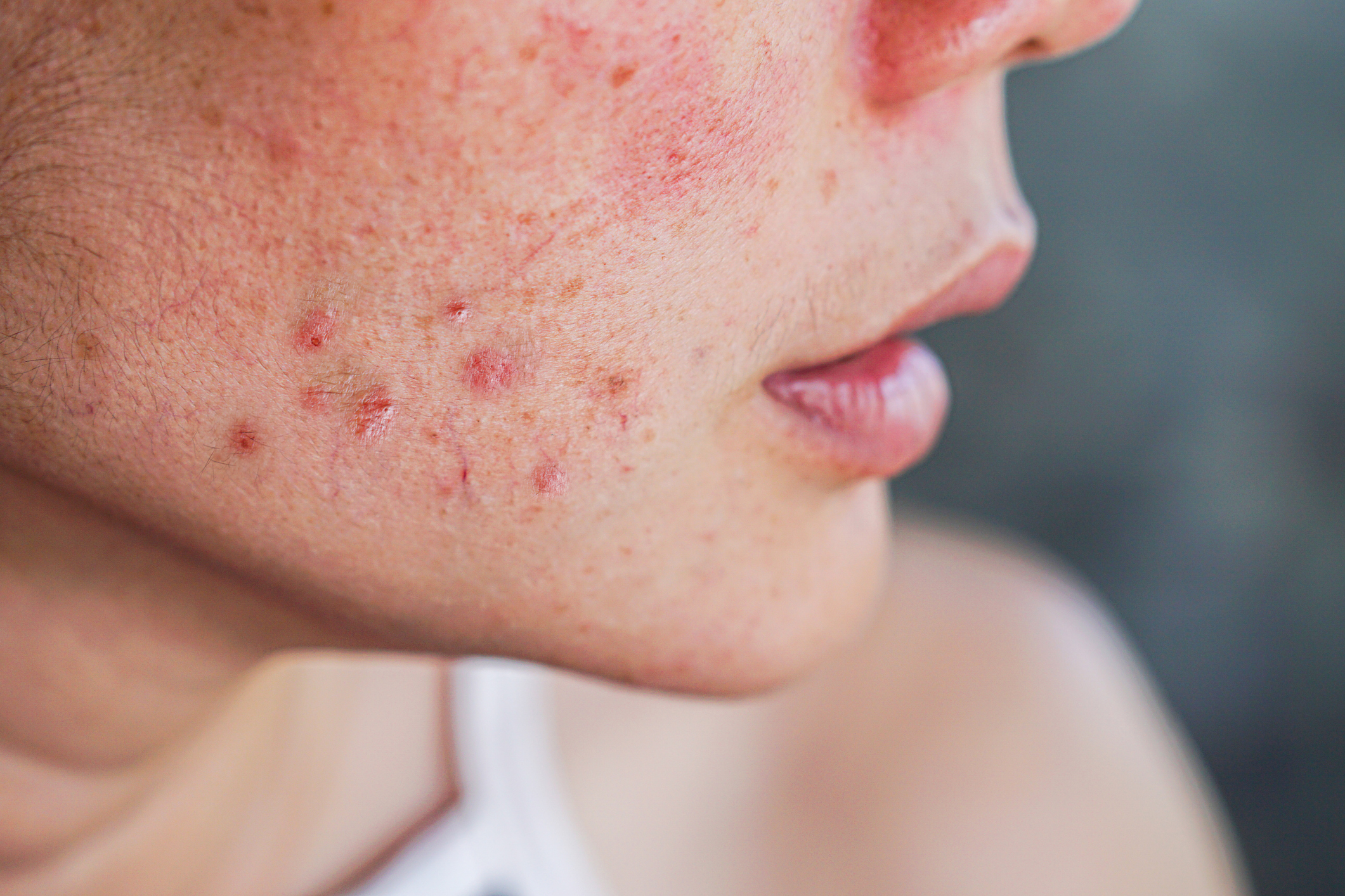 PCOS Acne: Treat Hormonal Breakouts Naturally