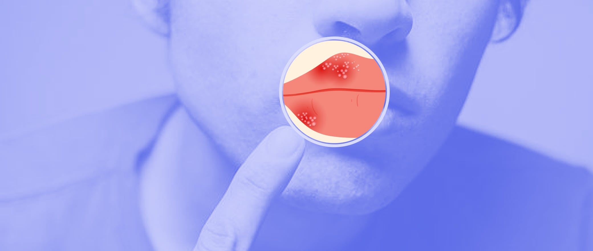 Is That a Cold Sore? All You Need to Know About Herpes