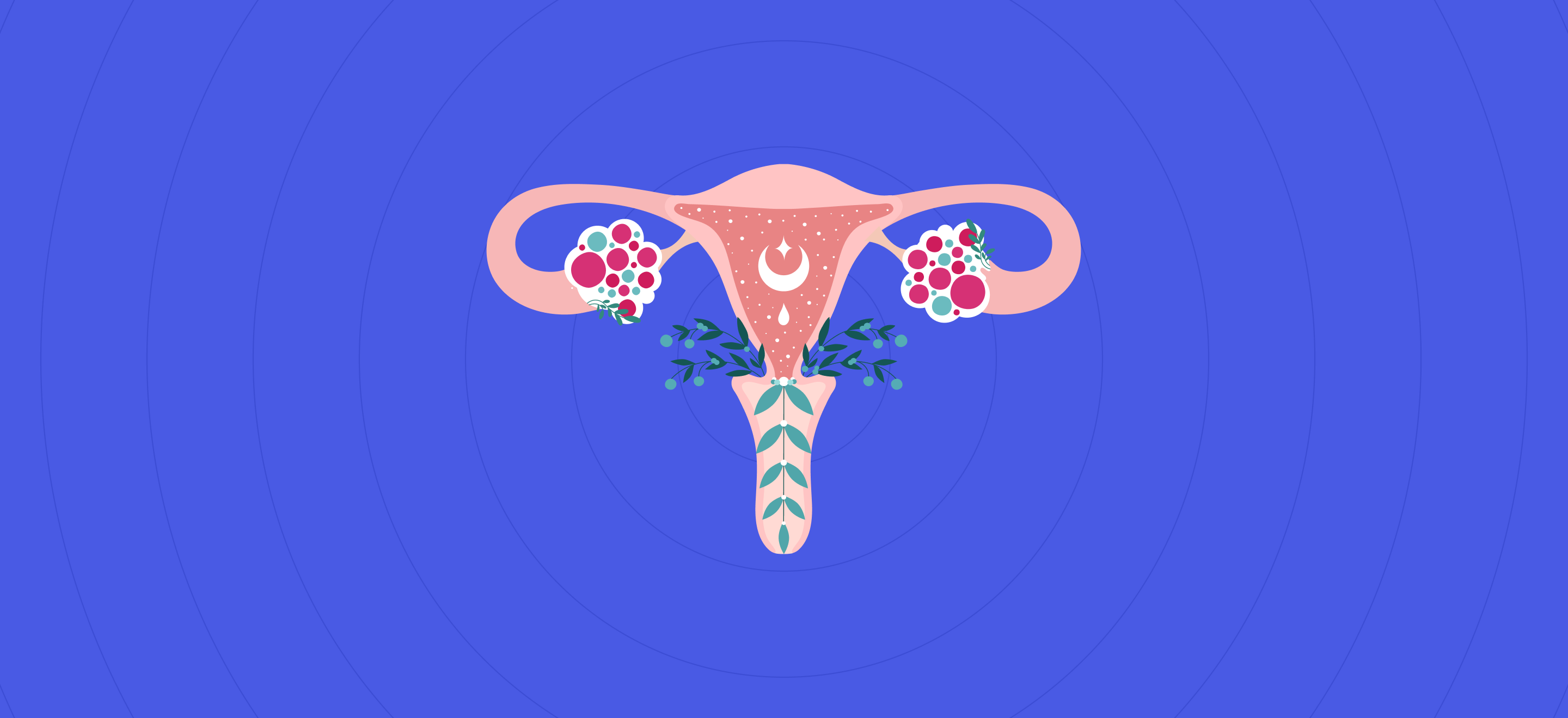 Bilateral Polycystic Ovaries: What It Means & Its PCOS Link