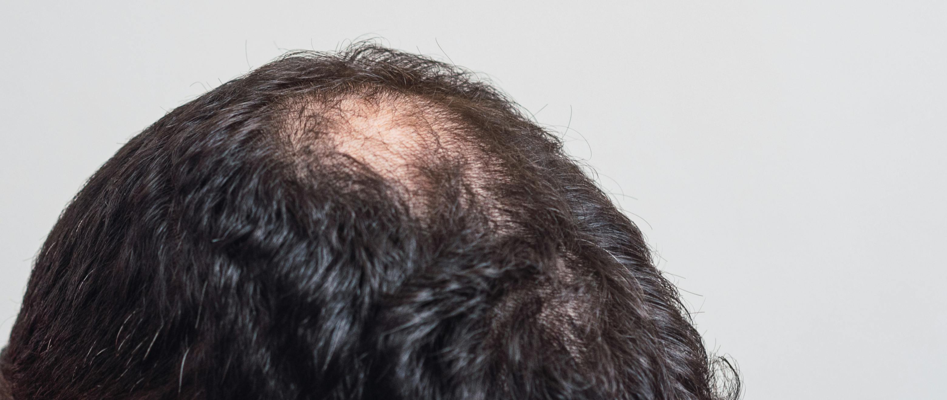 Oops, I Shed It Again: All About Alopecia Areata