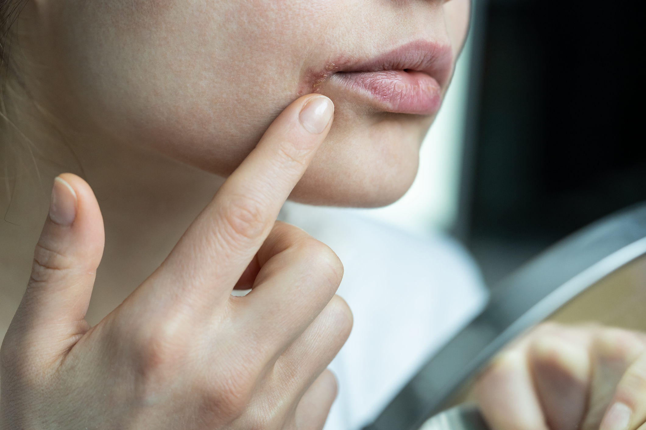 Herpes Symptoms in Women: Spotting the Signs Early