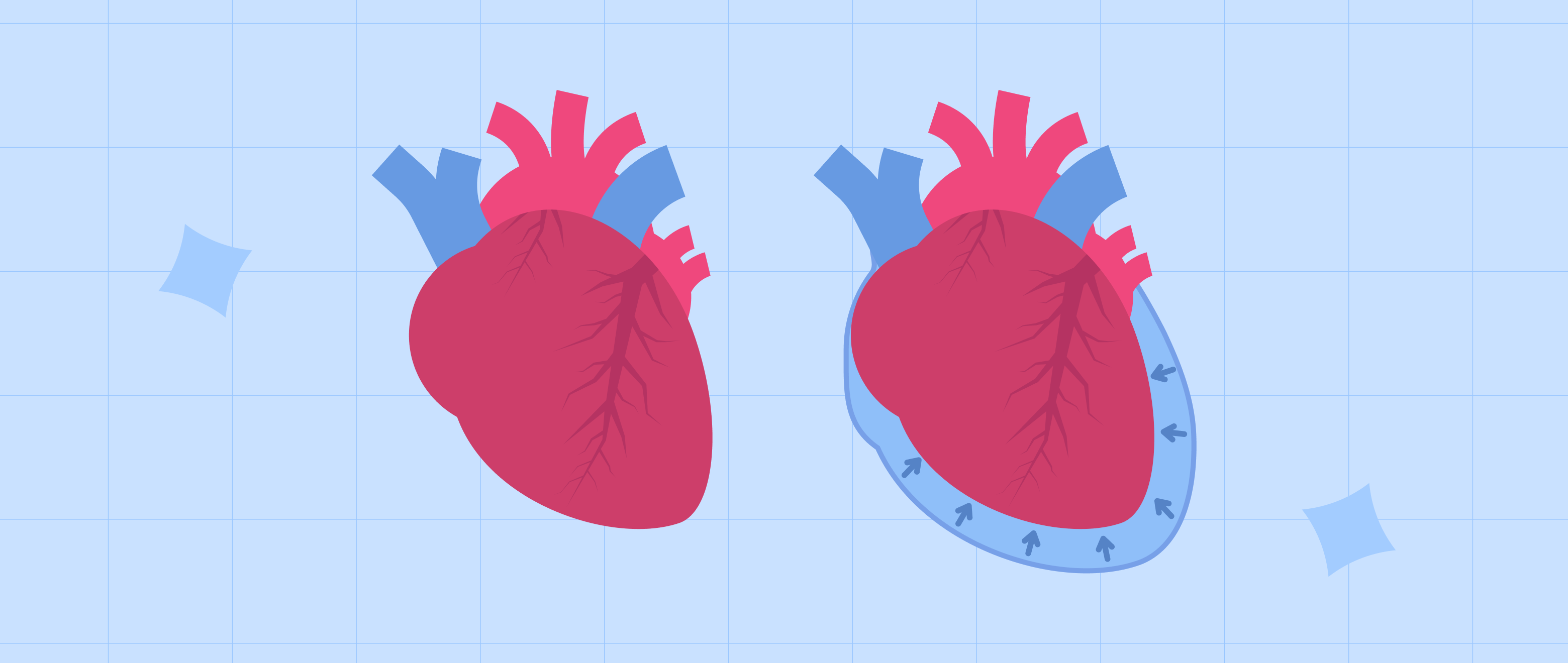 Cardiac Tamponade: Could Your Heart Be in a Fluid Jam?