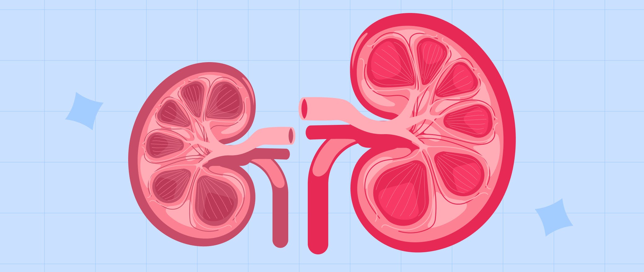 Decoding Hydronephrosis: Unravelling Causes & Relief