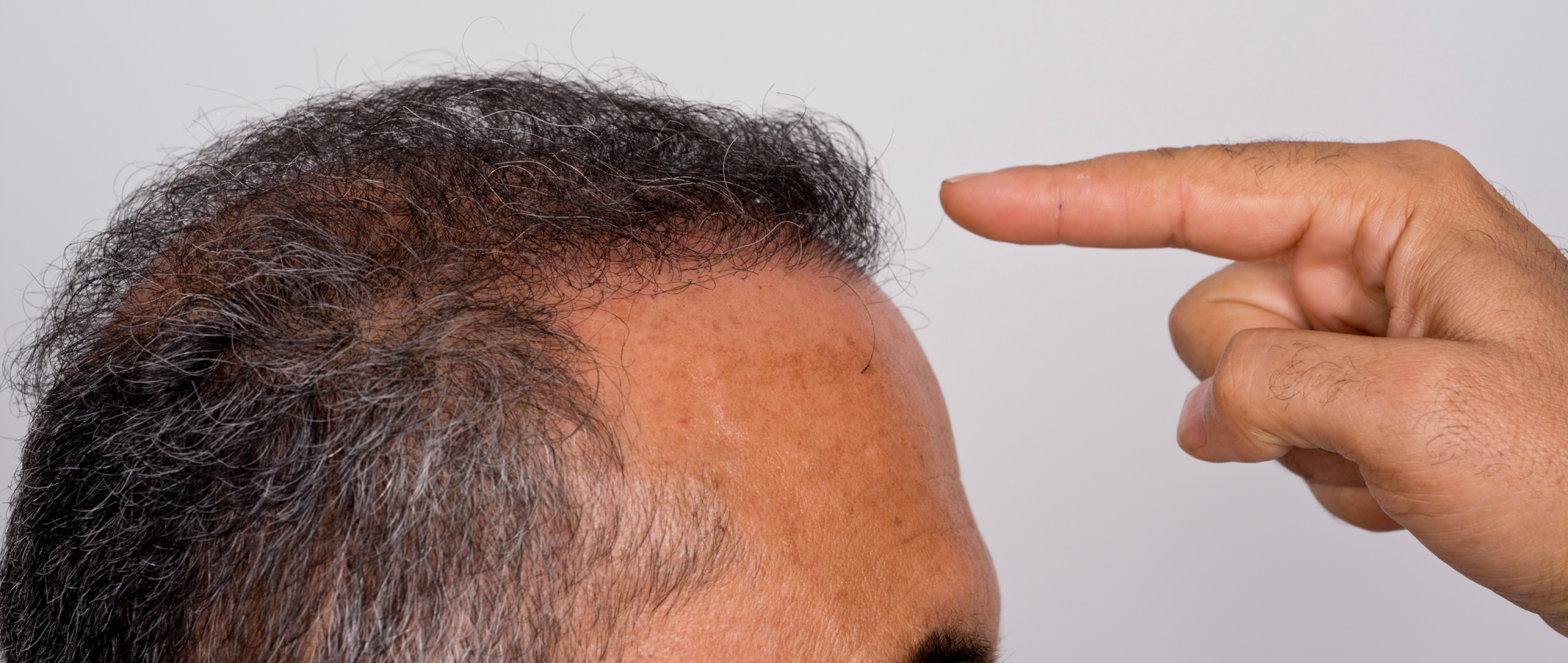 Hair Today, Gone Tomorrow: The Role of DHT