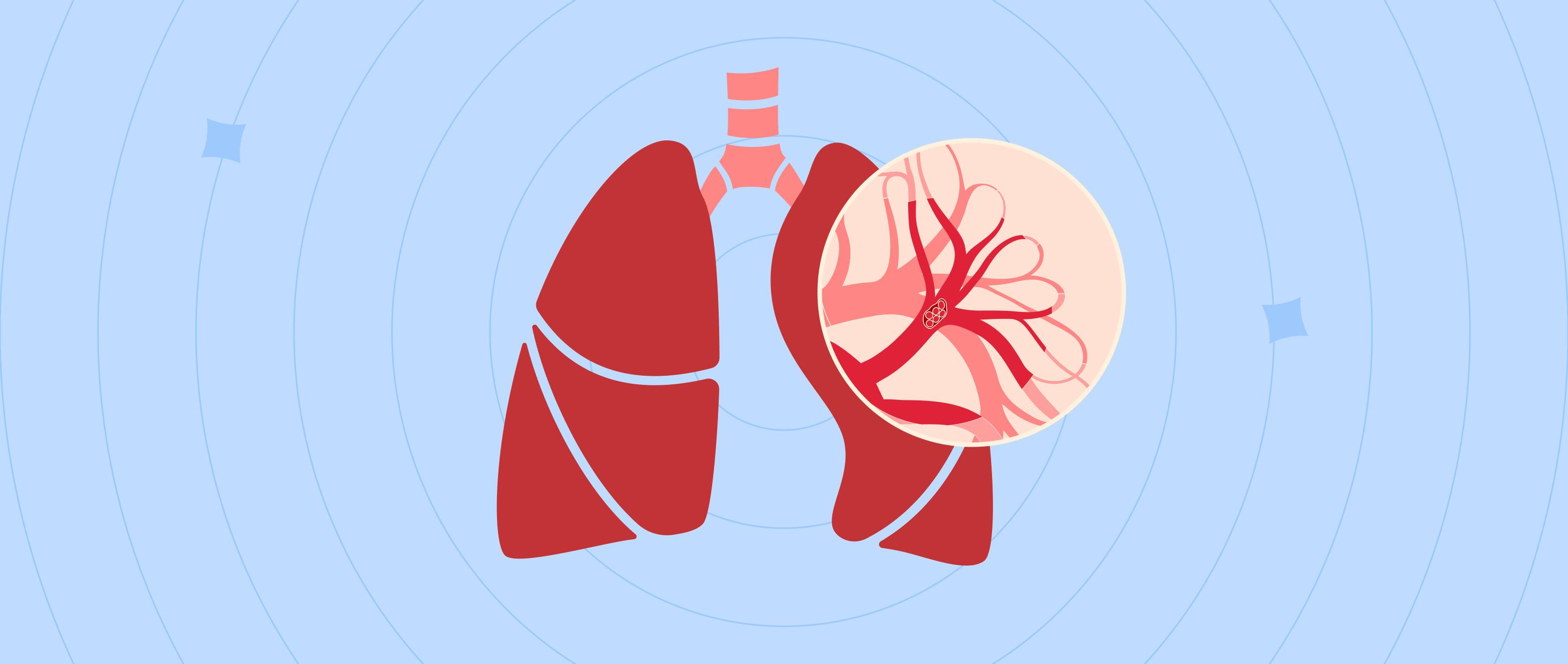 Understanding Pulmonary Embolism: A Blockage in Your Lungs