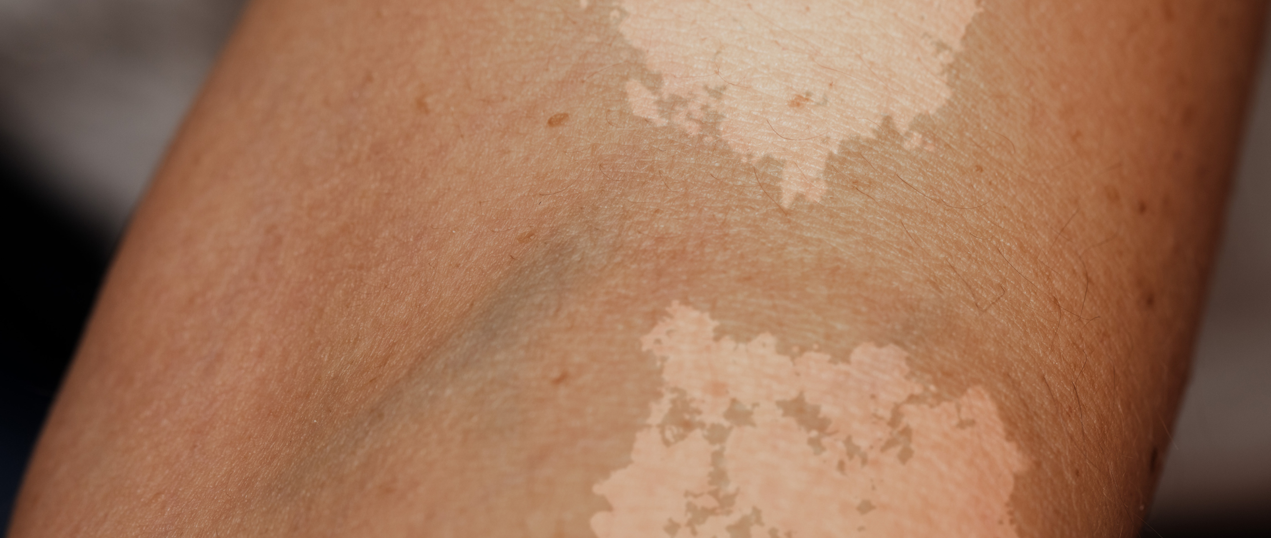 Is Your Skin Playing Holi Year-Round? It Could Be Tinea Versicolor 