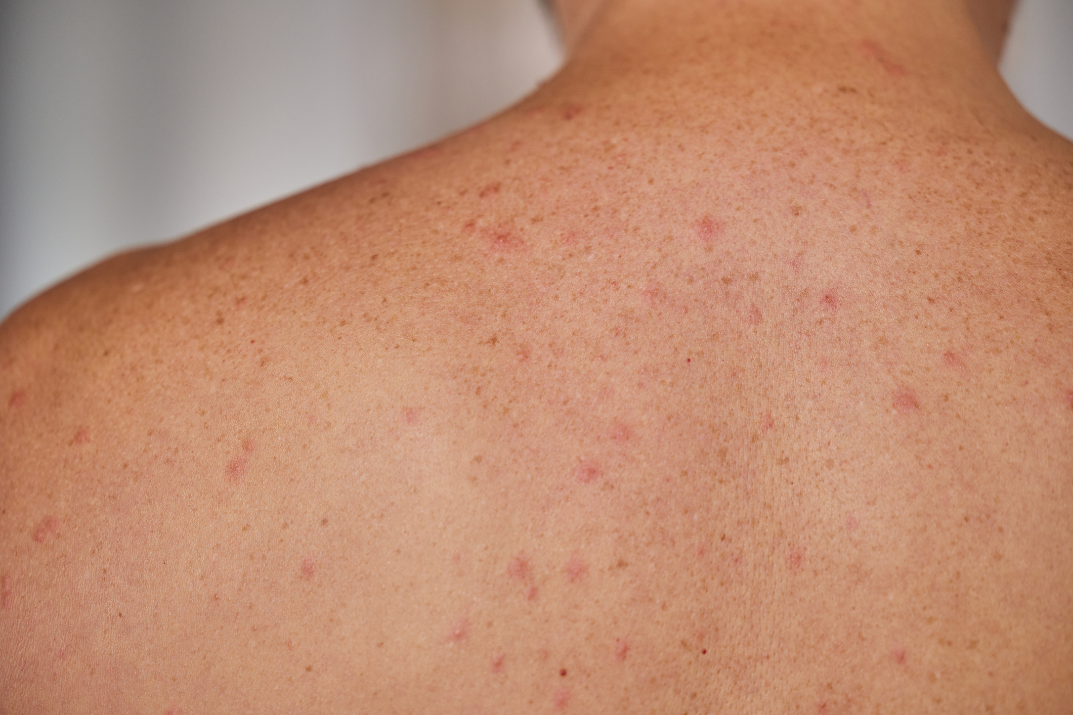 Keratosis Pilaris: Causes, Symptoms, and Treatment