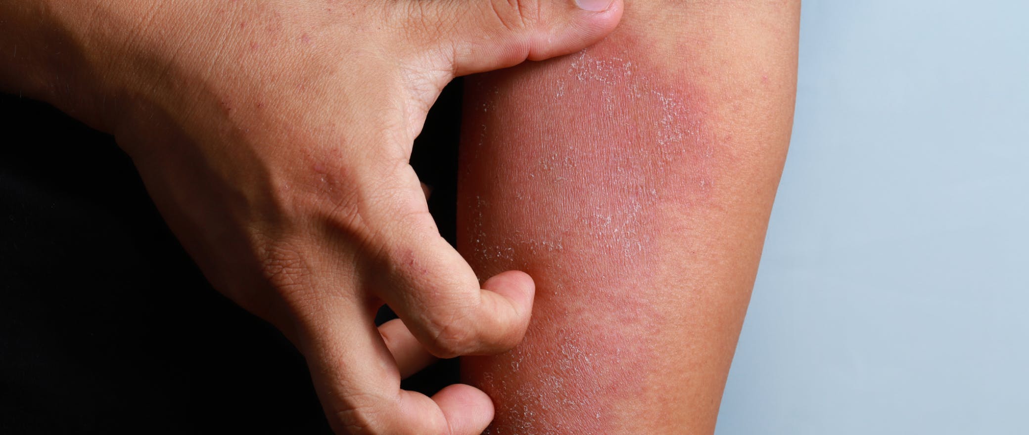 Fight The Flare Up: Everything You Need To Know About Eczema