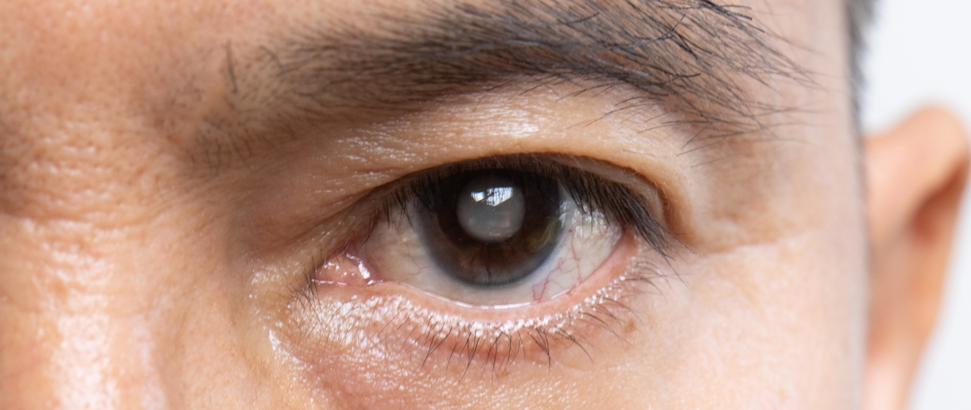 Protect Your Eyes: Don’t Let Glaucoma Cloud Your View