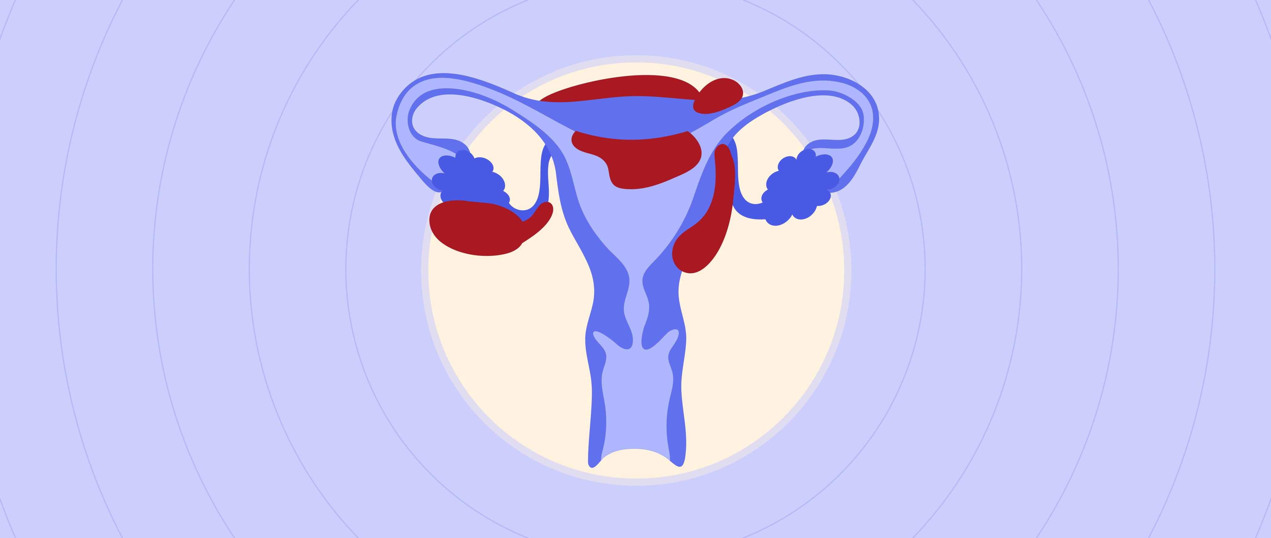 Beyond the Bellyache: Understanding Endometriosis