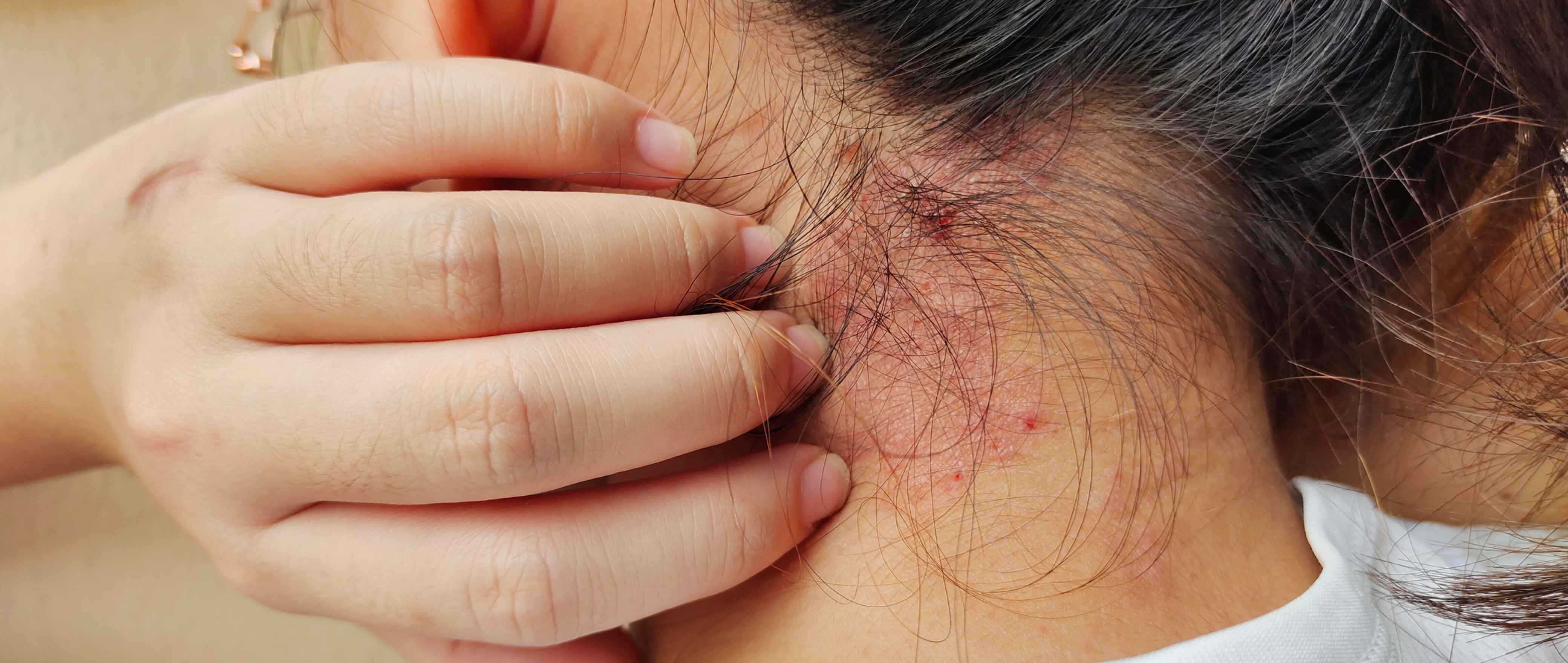 What Is Impetigo? Symptoms, Causes, and Treatment Explained