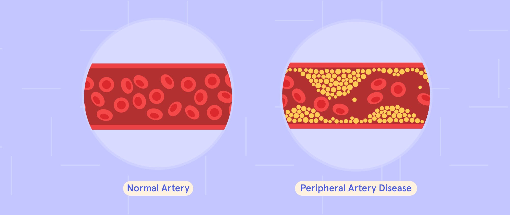 No More Leg Cramps: Outsmart Peripheral Artery Disease