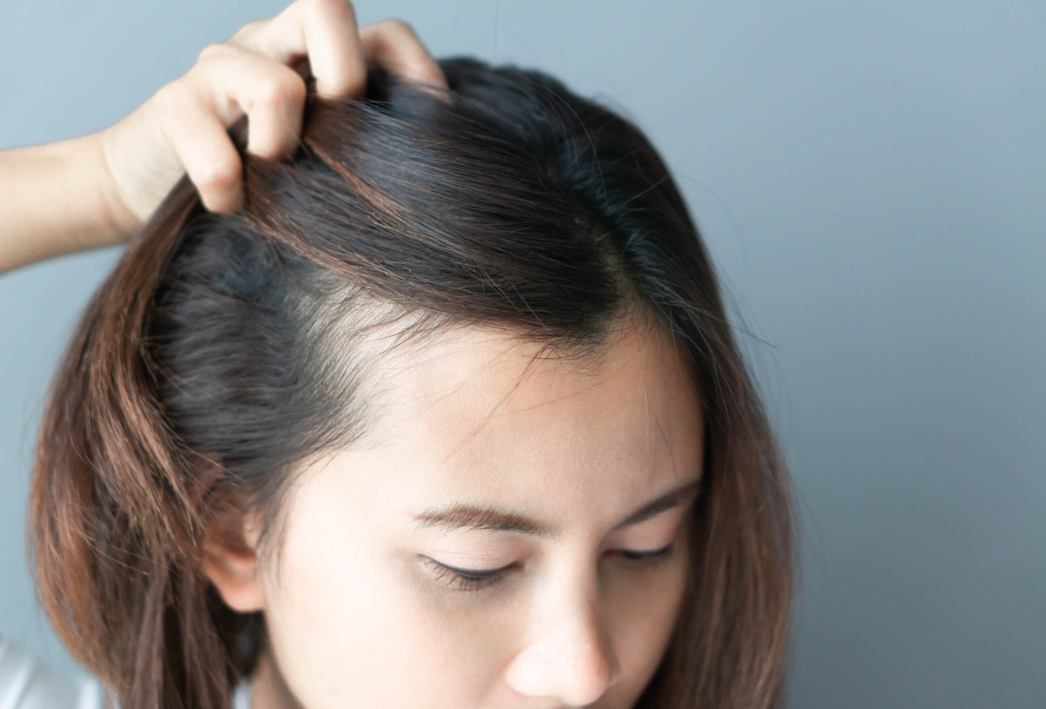 PCOS Hair Thinning: Causes & Ways to Reverse It