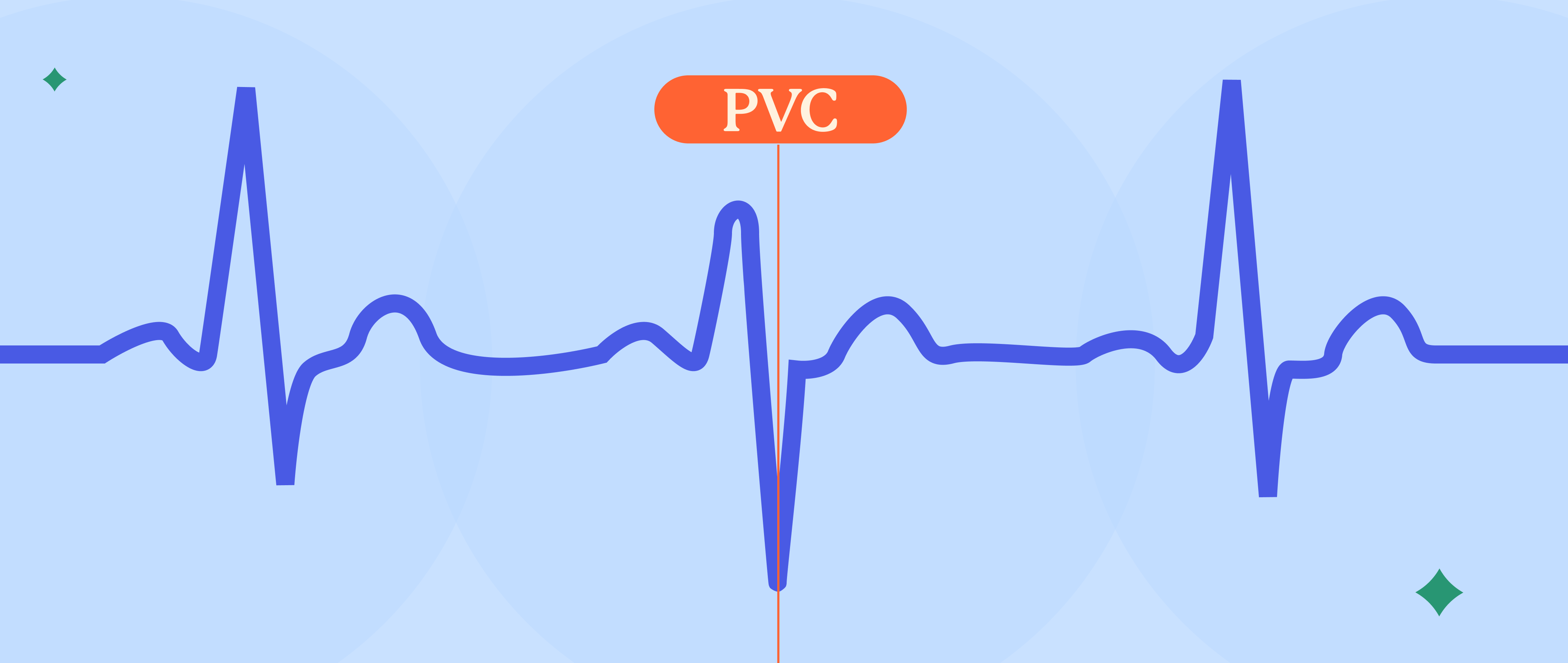 Premature Ventricular Contractions: Is Your Heart Freestyling?