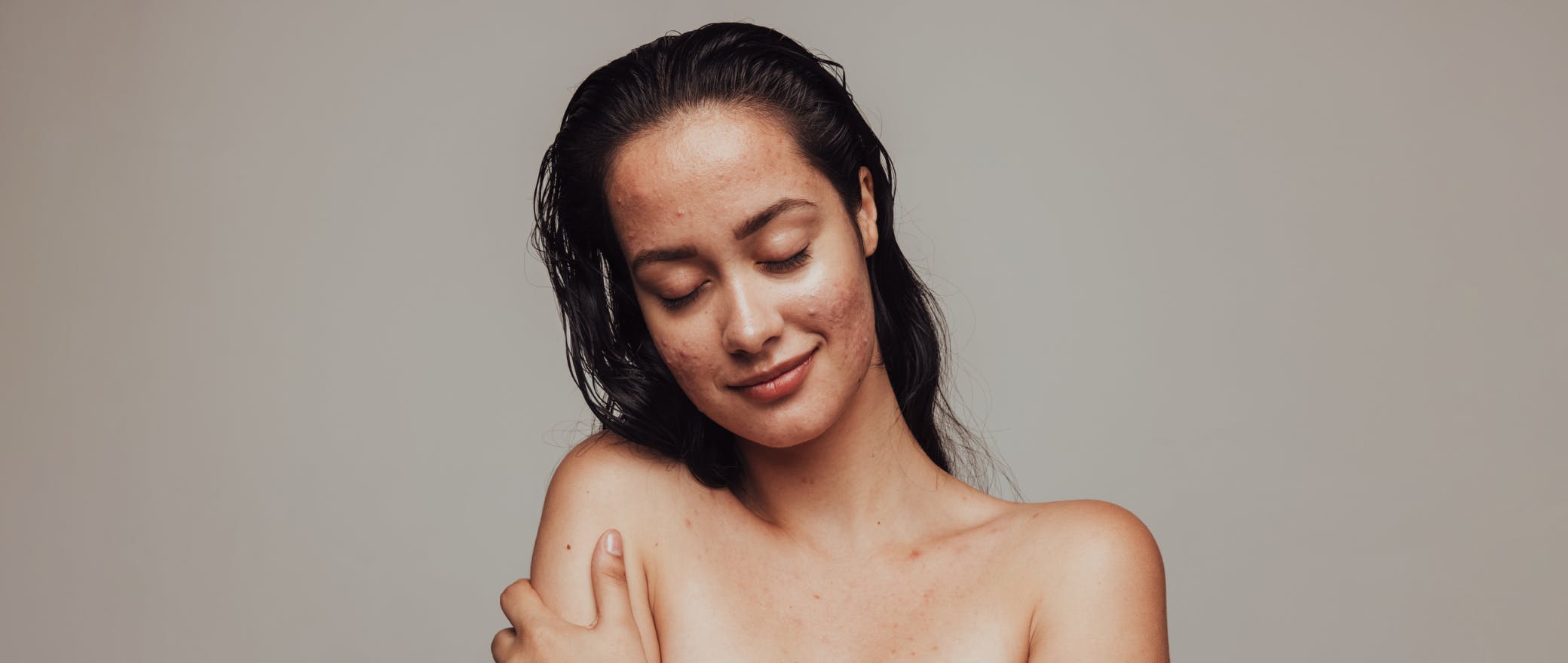Making a Mark: Learn About the Types of Acne Scars & How To Manage Them