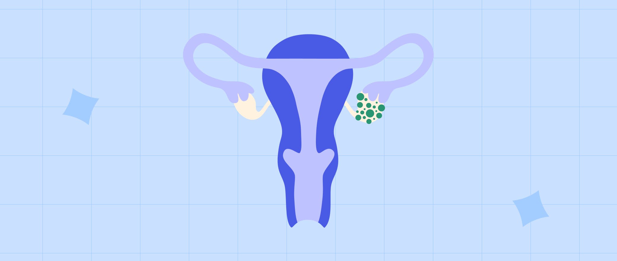 Pelvic Pain Doubling You Down? It’s Time to Learn About Ovarian Cysts