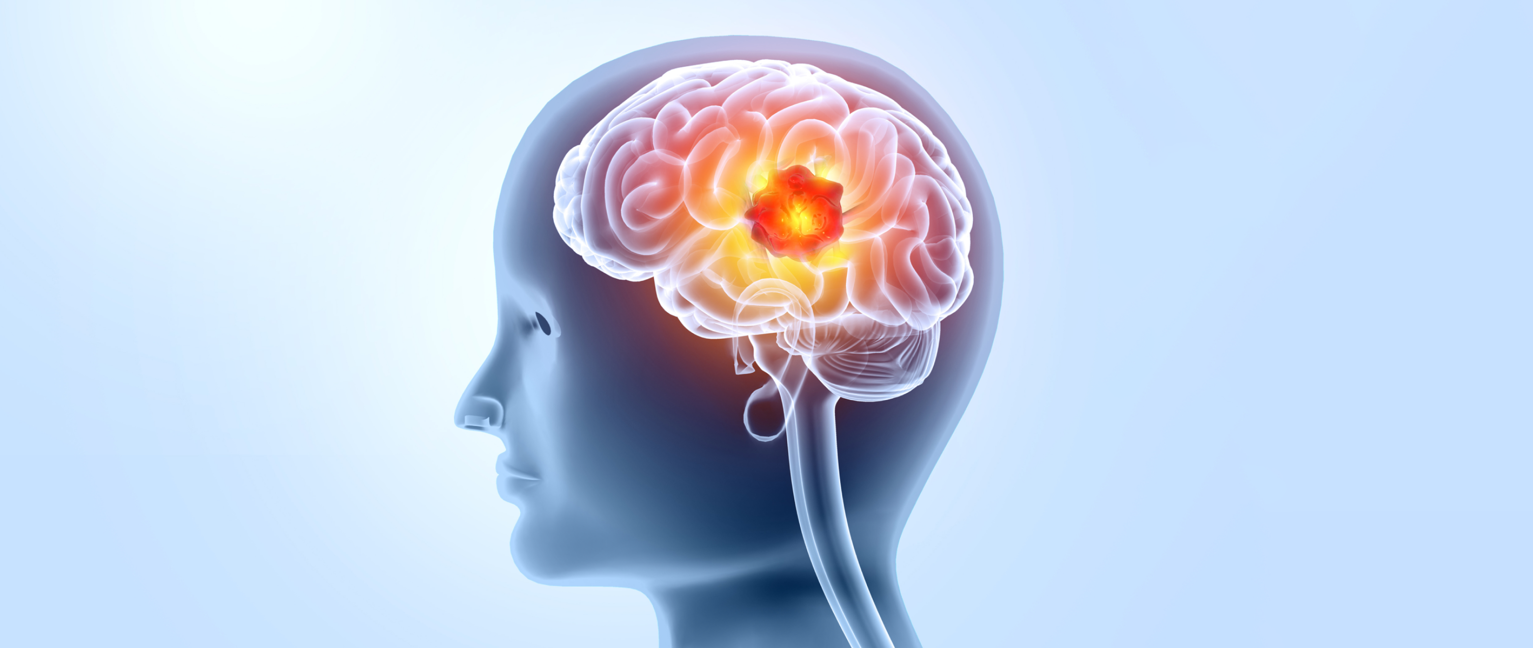Think It’s Just Stress? Know the Surprising Signs of Glioma
