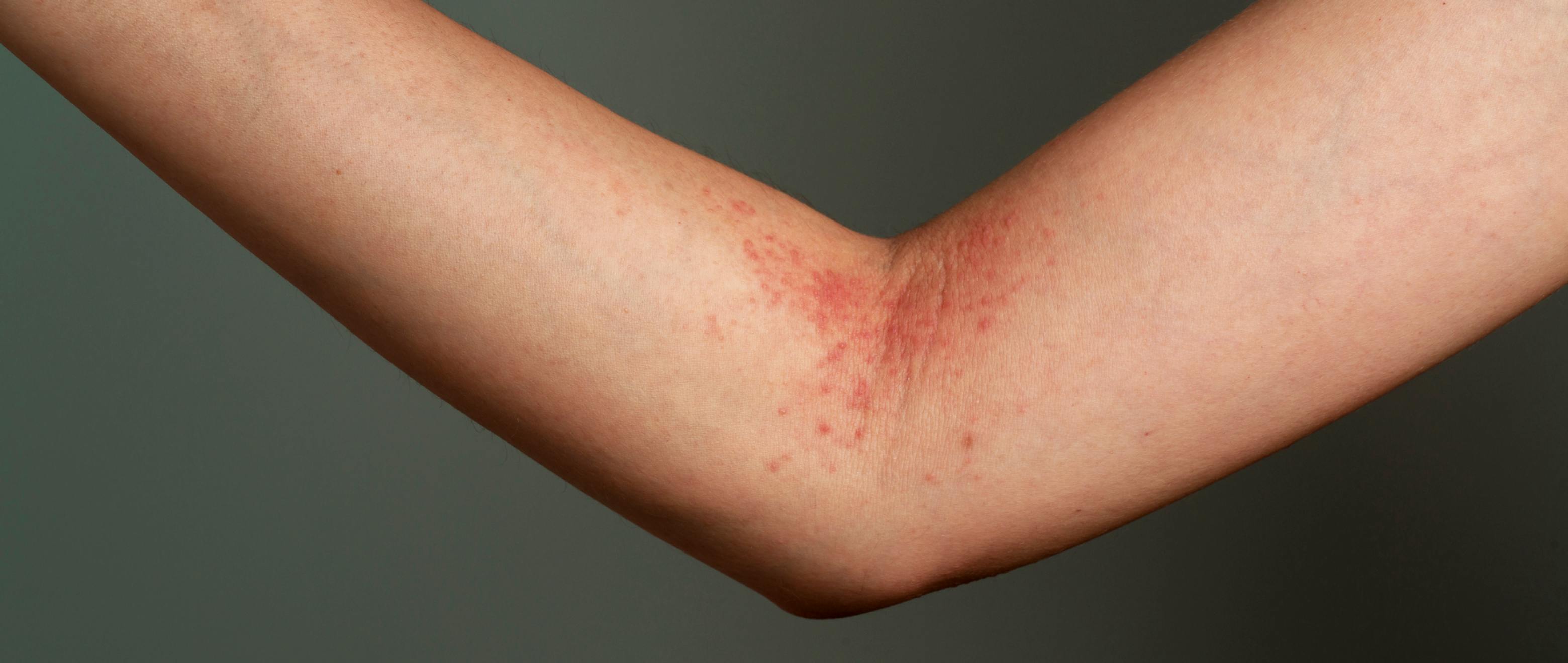Itch, Please! Defeating Contact Dermatitis