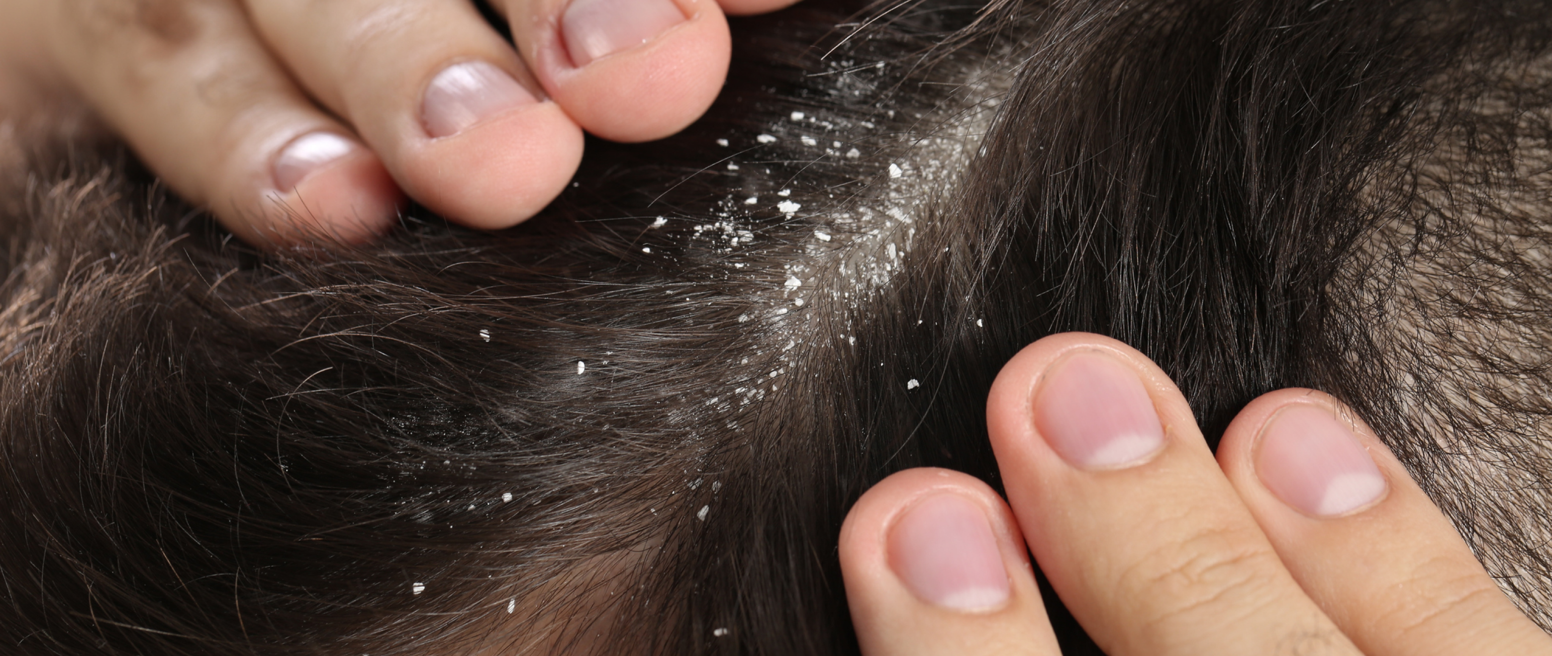 Bye-bye, Snowflakes! How to Get Rid of Dandruff for Good